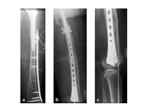 3-5LockingAttachmentPlate_10