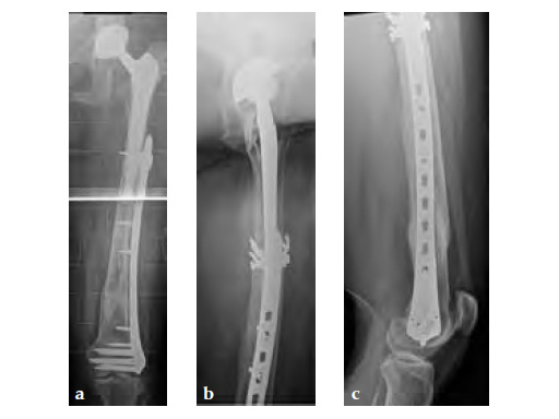 3-5LockingAttachmentPlate_11