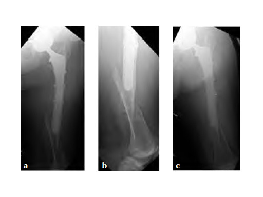 3-5LockingAttachmentPlate_4