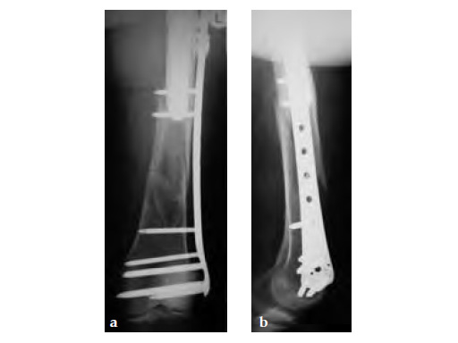 3-5LockingAttachmentPlate_7