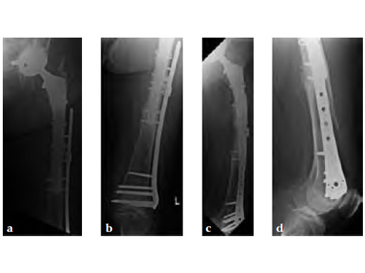 3-5LockingAttachmentPlate_8