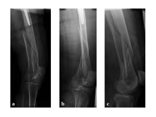 3-5LockingAttachmentPlate_9