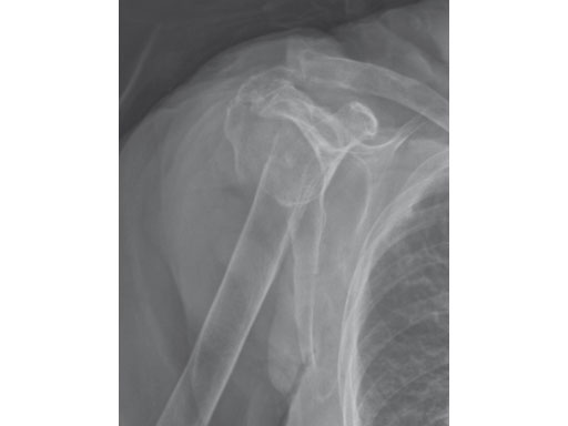 3-5mmLCPPercutaneousAimingSystemforPHILOS_2