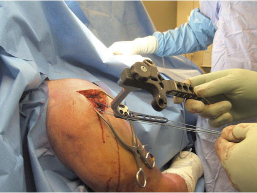 3-5mmLCPPercutaneousAimingSystemforPHILOS_3