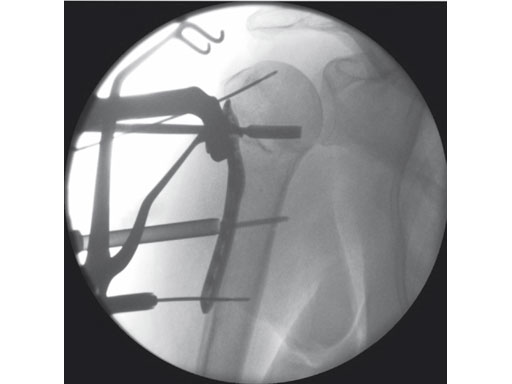 3-5mmLCPPercutaneousAimingSystemforPHILOS_4