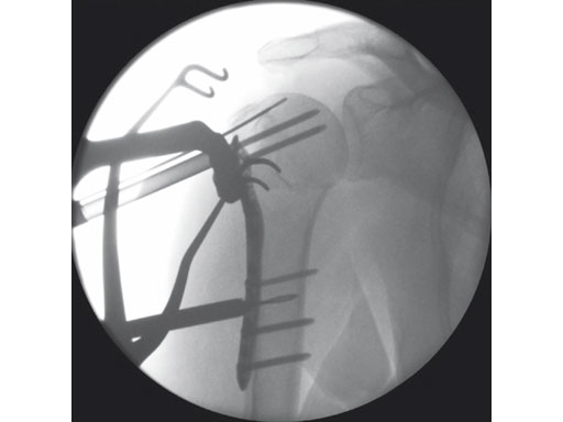 3-5mmLCPPercutaneousAimingSystemforPHILOS_5