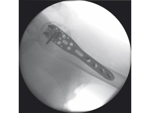 3-5mmLCPPercutaneousAimingSystemforPHILOS_6