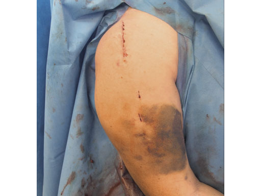 3-5mmLCPPercutaneousAimingSystemforPHILOS_7