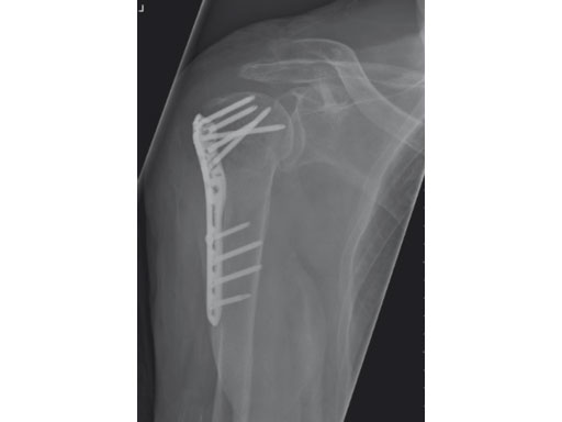 3-5mmLCPPercutaneousAimingSystemforPHILOS_8