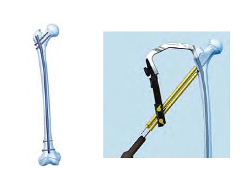 AdolescentLateralEntryFemoralNail_1