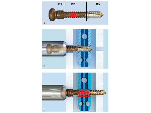 AngularStableLockingofIntramedullaryNailsASLS_2
