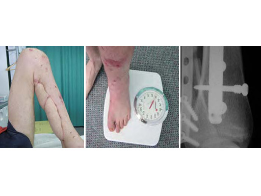 AngularStableLockingofIntramedullaryNailsASLS_4