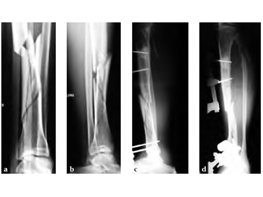 AngularStableLockingofIntramedullaryNailsASLS_5