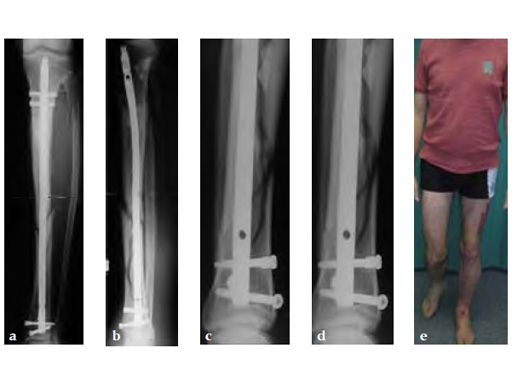 AngularStableLockingofIntramedullaryNailsASLS_6