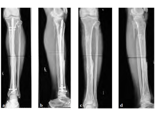 AngularStableLockingofIntramedullaryNailsASLS_7