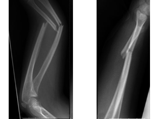 EndCapsSmallforTENandSTEN_2