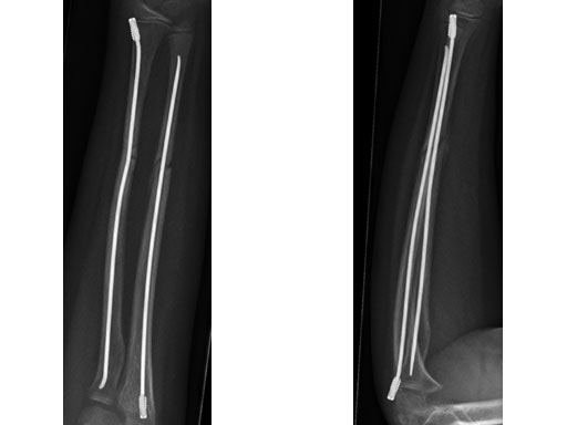 EndCapsSmallforTENandSTEN_3