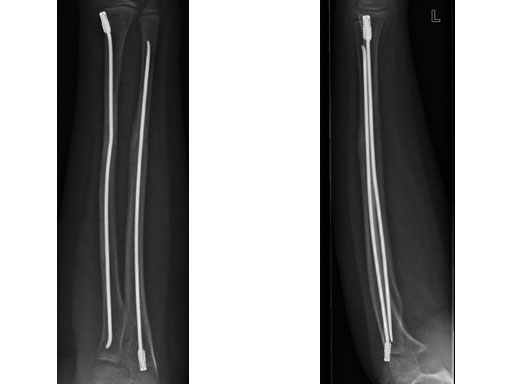 EndCapsSmallforTENandSTEN_4