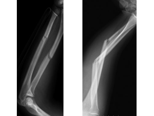 EndCapsSmallforTENandSTEN_5