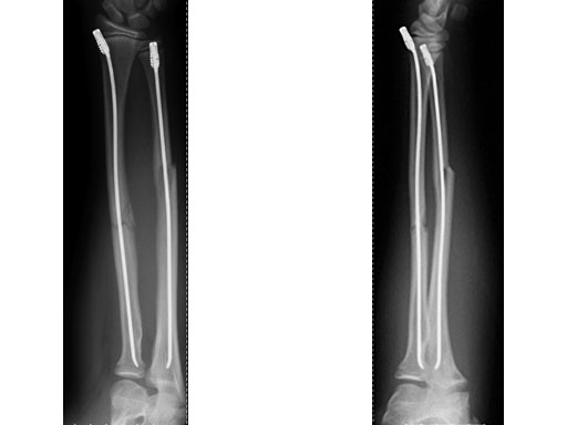 EndCapsSmallforTENandSTEN_6