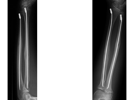 EndCapsSmallforTENandSTEN_7