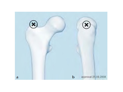 ExpertAsianFemoralNailA2FN_1