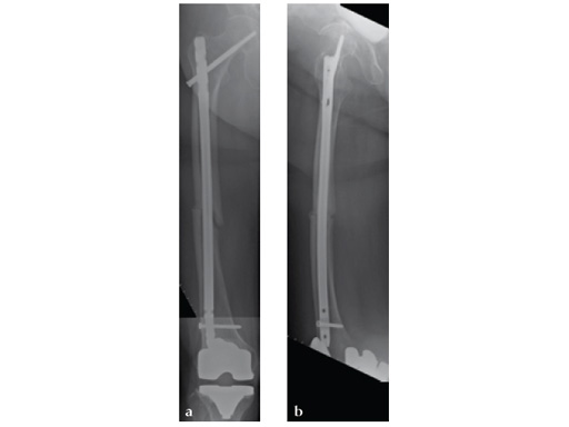 ExpertAsianFemoralNailA2FN_14