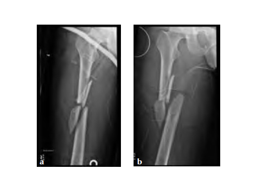 ExpertAsianFemoralNailA2FN_4