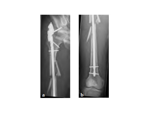 ExpertAsianFemoralNailA2FN_5