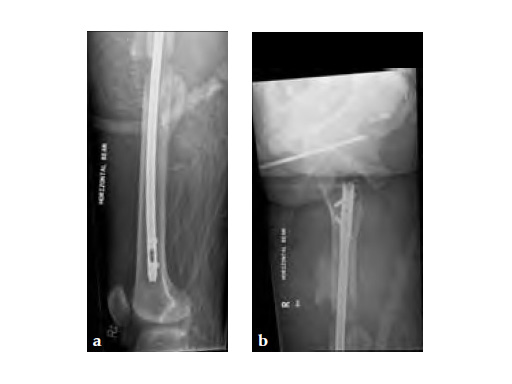 ExpertAsianFemoralNailA2FN_6