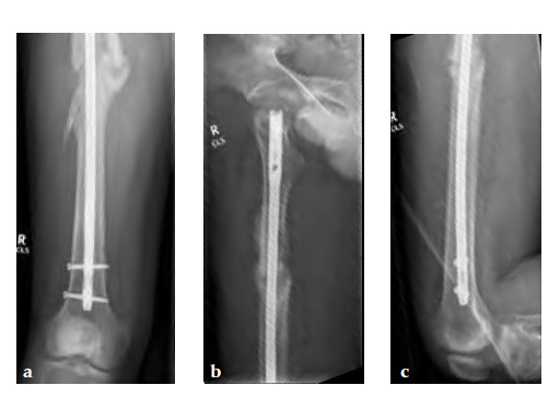ExpertAsianFemoralNailA2FN_7
