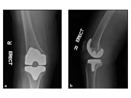 ExpertAsianFemoralNailA2FN_8