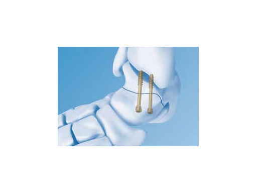 HeadlessCompressionScrew4-5mmand6-5mm_1