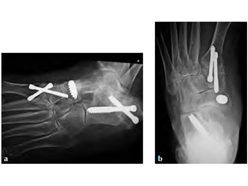 HeadlessCompressionScrew4-5mmand6-5mm_10