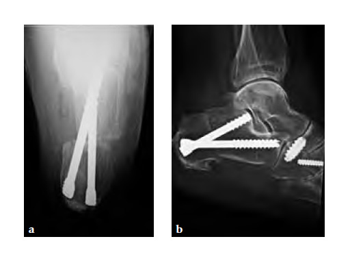 HeadlessCompressionScrew4-5mmand6-5mm_11