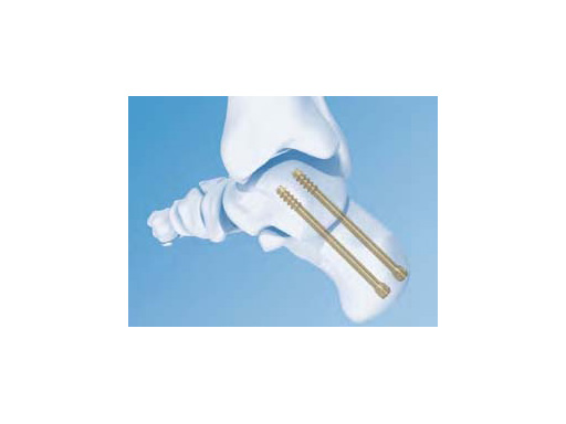 HeadlessCompressionScrew4-5mmand6-5mm_3