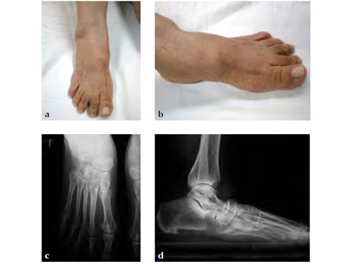 HeadlessCompressionScrew4-5mmand6-5mm_5
