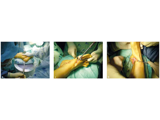 HeadlessCompressionScrew4-5mmand6-5mm_6