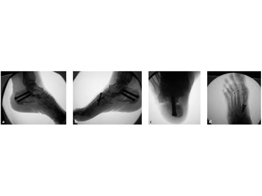 HeadlessCompressionScrew4-5mmand6-5mm_7