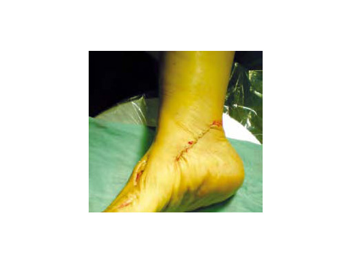 HeadlessCompressionScrew4-5mmand6-5mm_8