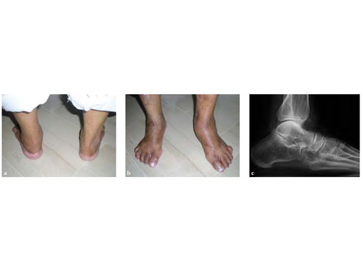 HeadlessCompressionScrew4-5mmand6-5mm_9