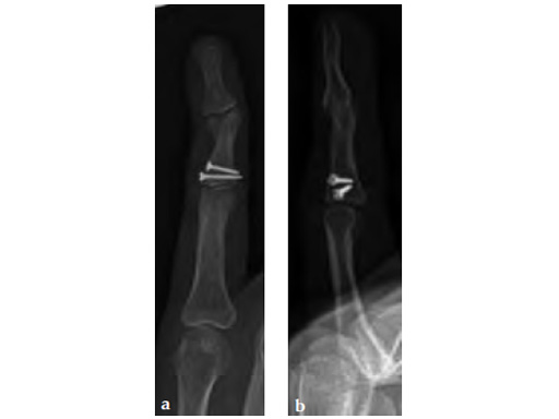 HeadlessCompressionScrewExtraSmallHCS1-5_2