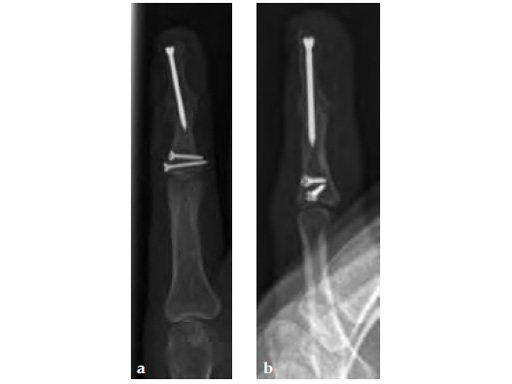 HeadlessCompressionScrewExtraSmallHCS1-5_3
