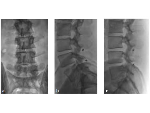 In-SpaceInterspinousDistraction_3