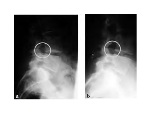 In-SpaceInterspinousDistraction_4