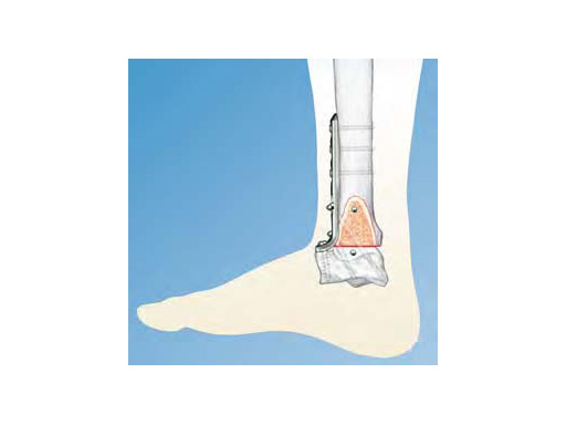 LCPAnteriorAnkleArthrodesis_2