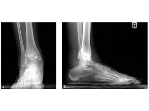 LCPAnteriorAnkleArthrodesis_4