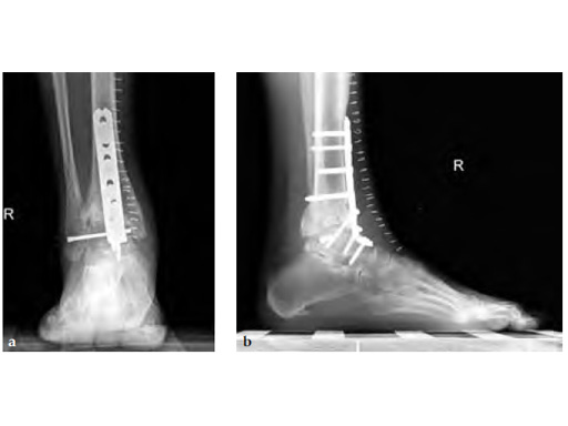 LCPAnteriorAnkleArthrodesis_5