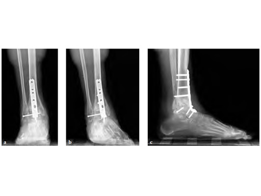 LCPAnteriorAnkleArthrodesis_6