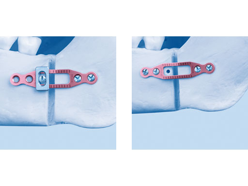 MatrixOrthognathicSystem_12